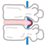 腰椎すべり症の症状